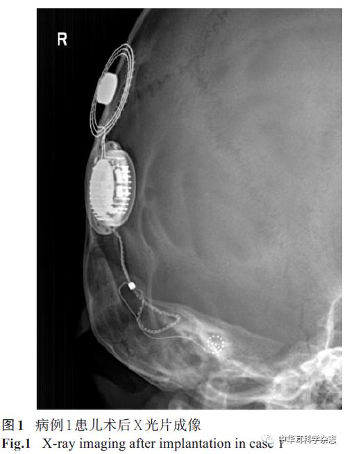 charge／charge综合征